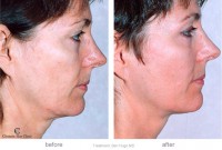 /album/skin-tightening-tips/thermage1-large-jpg1/
