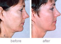 /album/skin-tightening-tips/thermage1-small-jpg1/