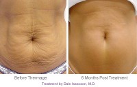 /album/skin-tightening-tips/thermage-abdomen-treatment-before-after-jpg1/