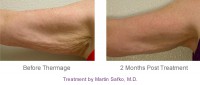 /album/skin-tightening-tips/thermage-body-procedure-arms-jpg1/