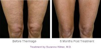 /album/skin-tightening-tips/thermage-body-procedure-knees-thighs-jpg1/