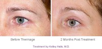 /album/skin-tightening-tips/thermage-eye-treatment-before-after-jpg1/