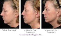/album/skin-tightening-tips/thermage-face-procedure-jpg1/
